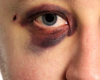 Dr. Zuhal Butuner Discusses the Effects of Eye Injuries
