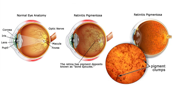 Dr. Zuhal Butuner Discusses the Causes, Symptoms, and Available Treatment Options of Retinitis Pigmentosa (RP)
